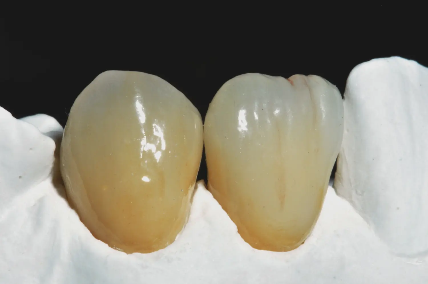 Zwei gelbe Zähne von Salza Dental GbR